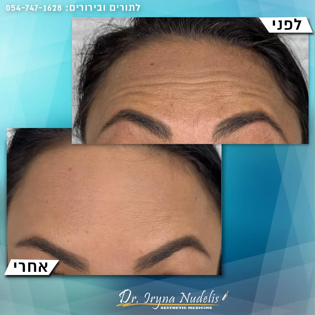 תמונת לפני ואחרי, מצח, תוצאה 1