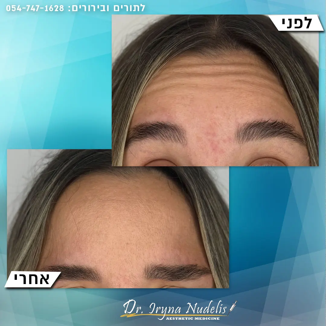 תמונת לפני ואחרי, מצח, תוצאה 2