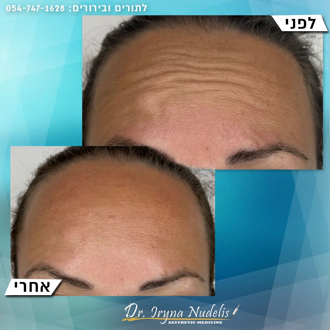 תמונת לפני ואחרי, מצח, תוצאה 3