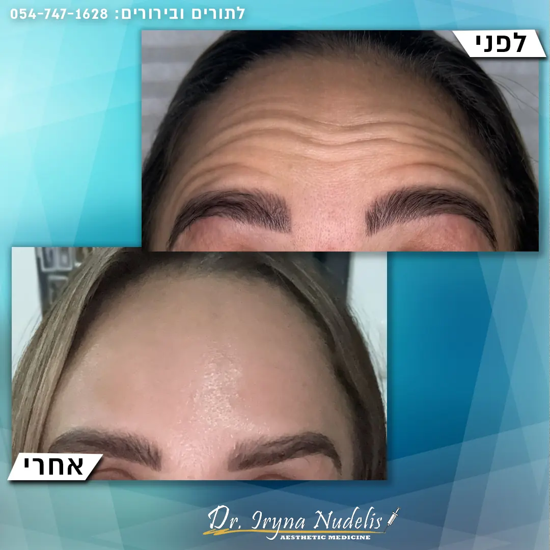 תמונת לפני ואחרי, מצח, תוצאה 4