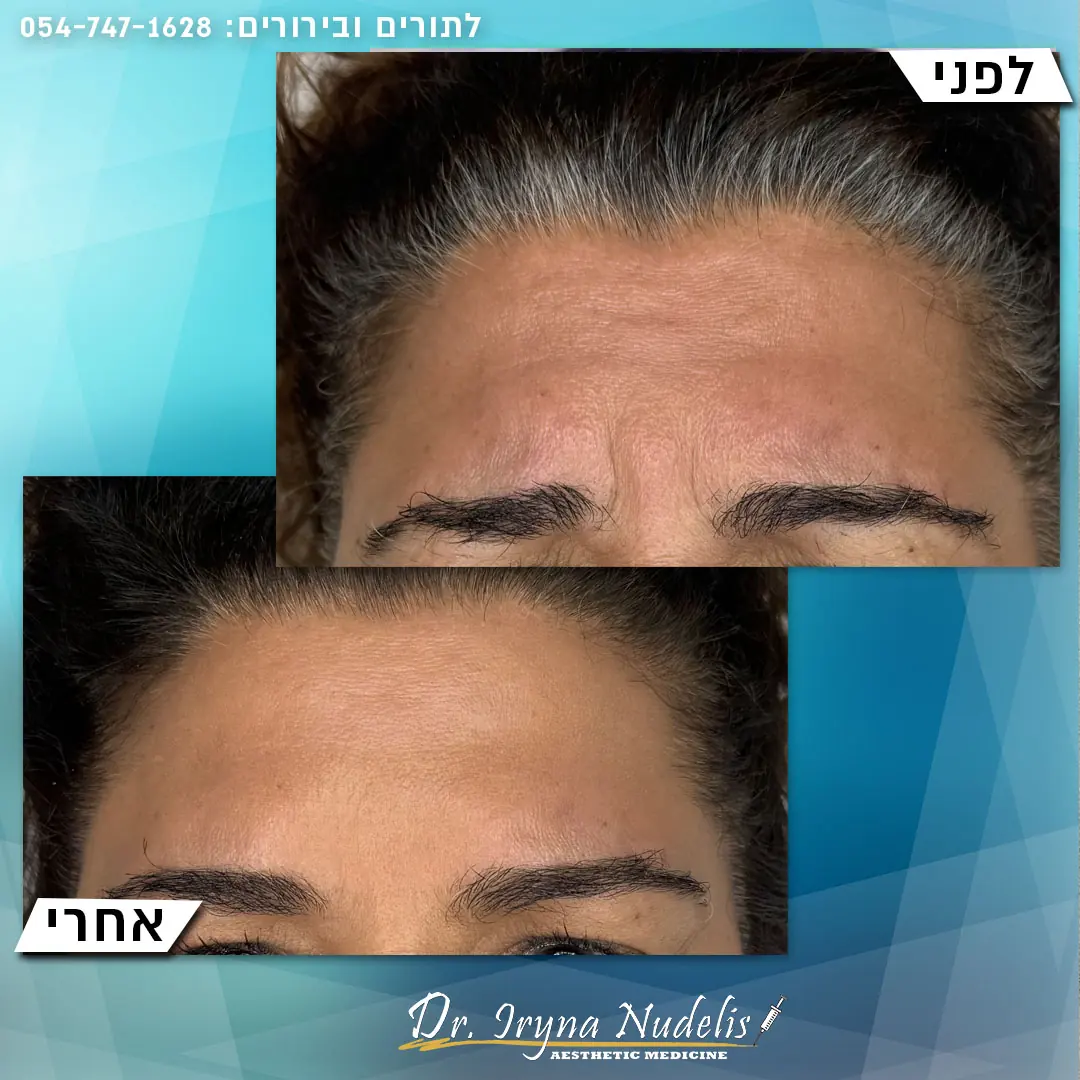 תמונת לפני ואחרי, מצח, תוצאה 5
