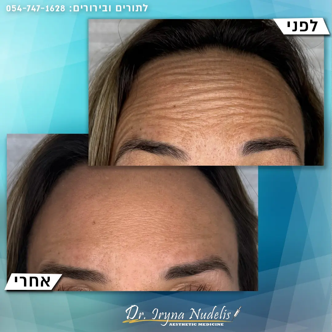 תמונת לפני ואחרי, מצח, תוצאה 6