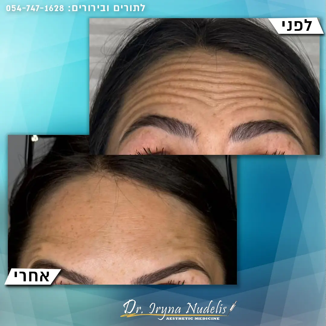 תמונת לפני ואחרי, מצח, תוצאה 7