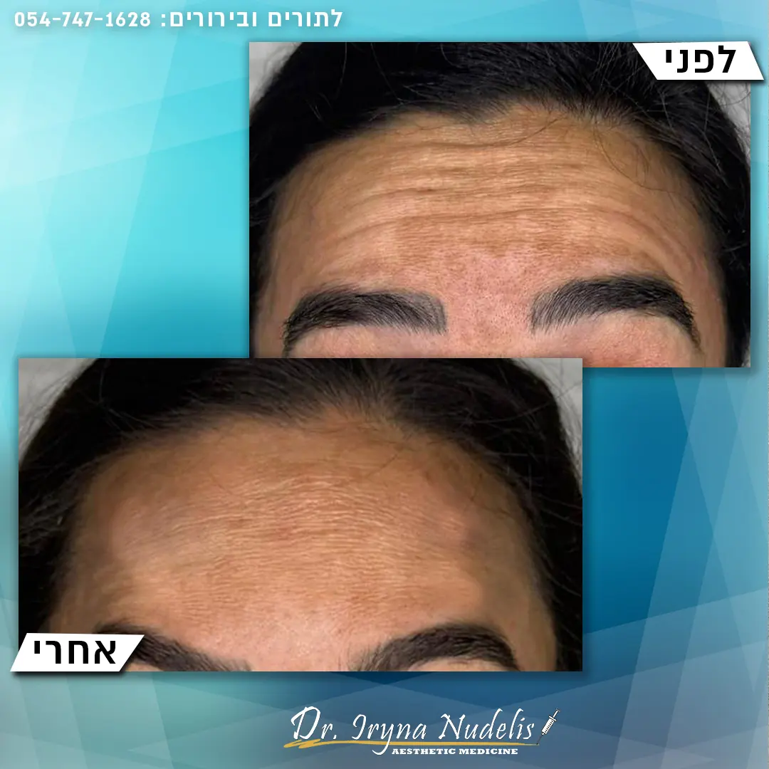 תמונת לפני ואחרי, מצח, תוצאה 8