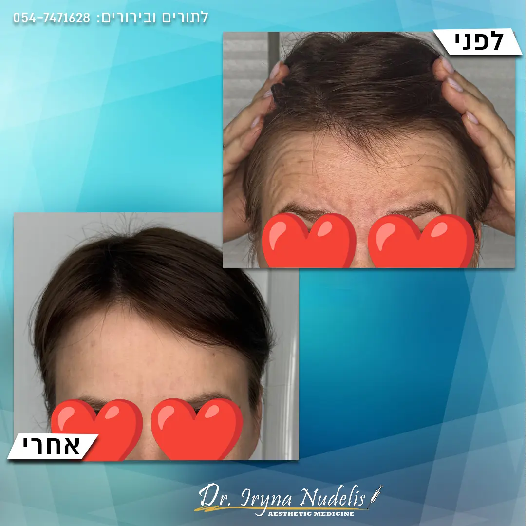 תמונת לפני ואחרי, מצח, תוצאה 9
