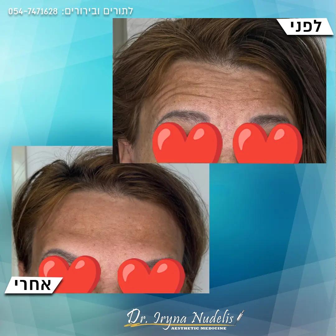 תמונת לפני ואחרי, מצח, תוצאה 10