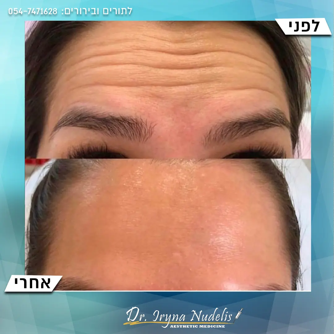 תמונת לפני ואחרי, מצח, תוצאה 11