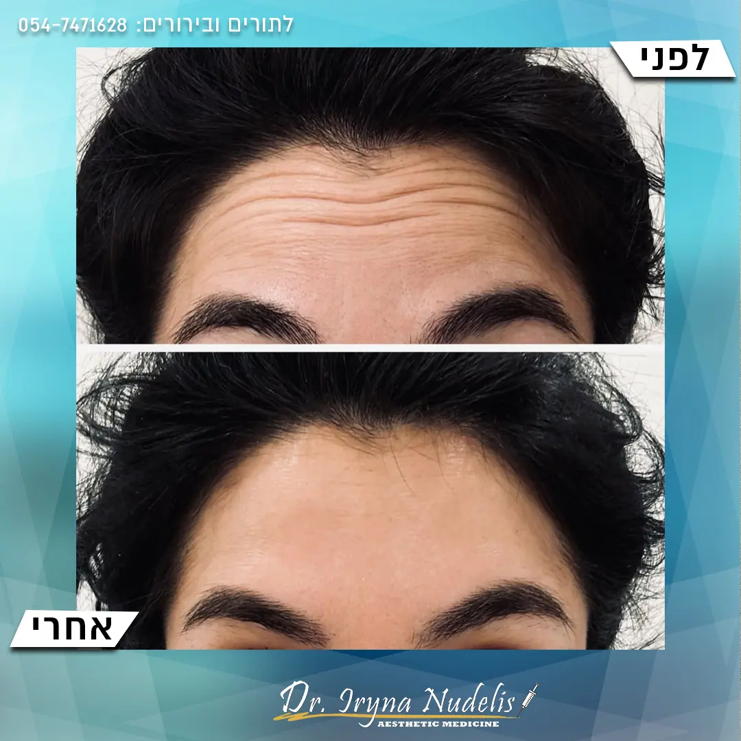 תמונת לפני ואחרי, מצח, תוצאה 12