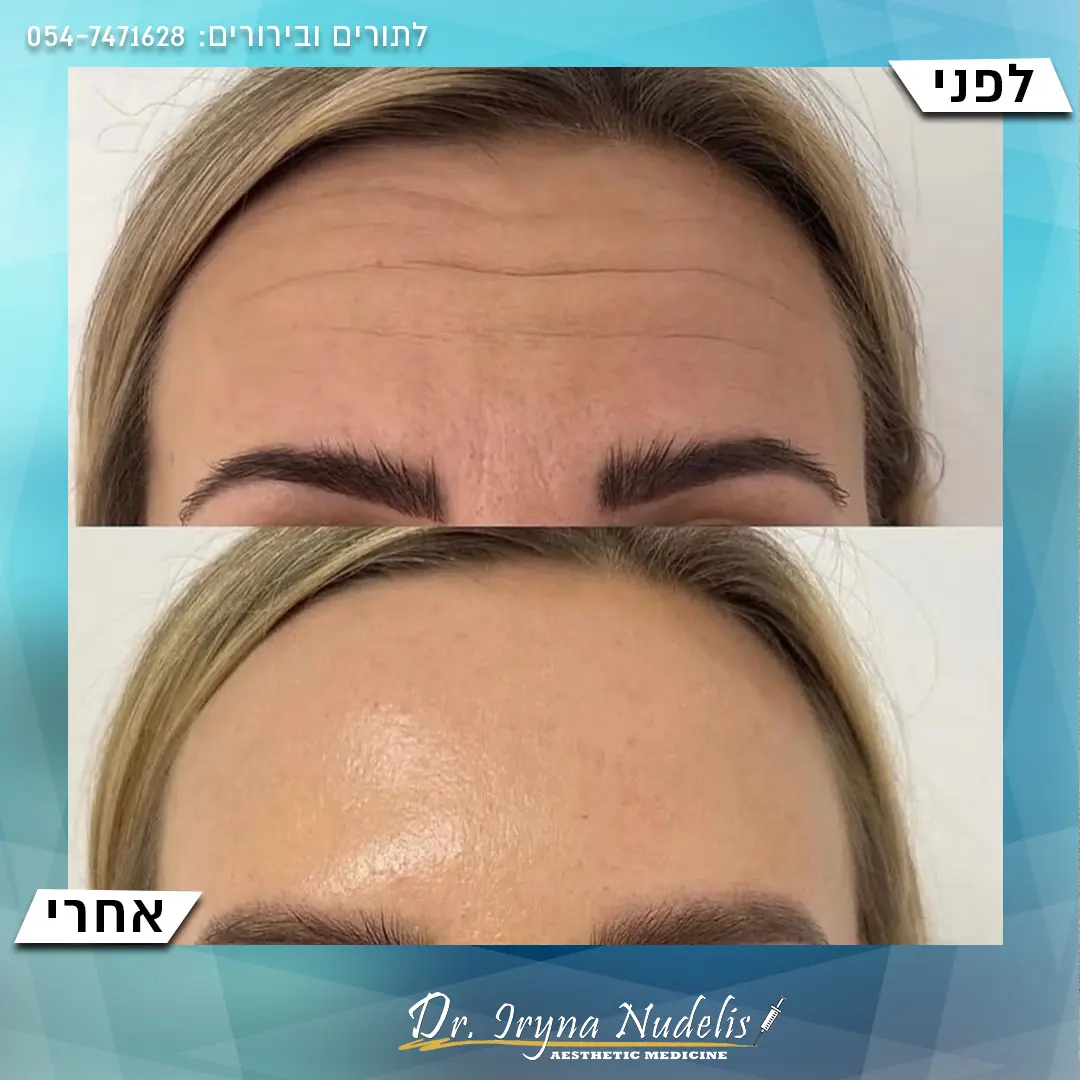 תמונת לפני ואחרי, מצח, תוצאה 13