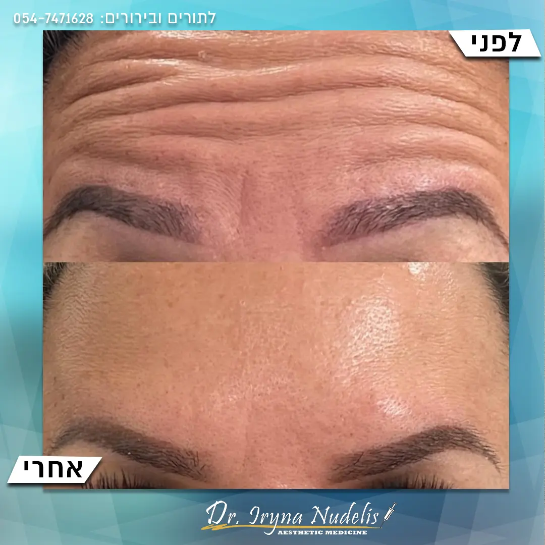 תמונת לפני ואחרי, מצח, תוצאה 14