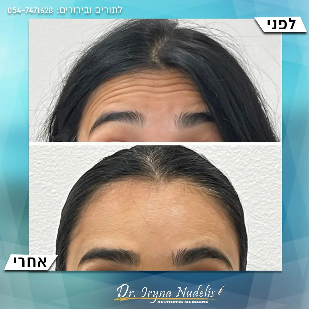 תמונת לפני ואחרי, מצח, תוצאה 15
