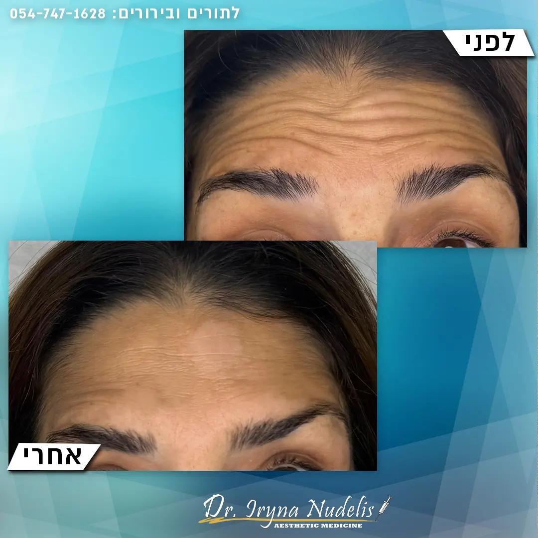 תמונת לפני ואחרי, מצח, תוצאה 16