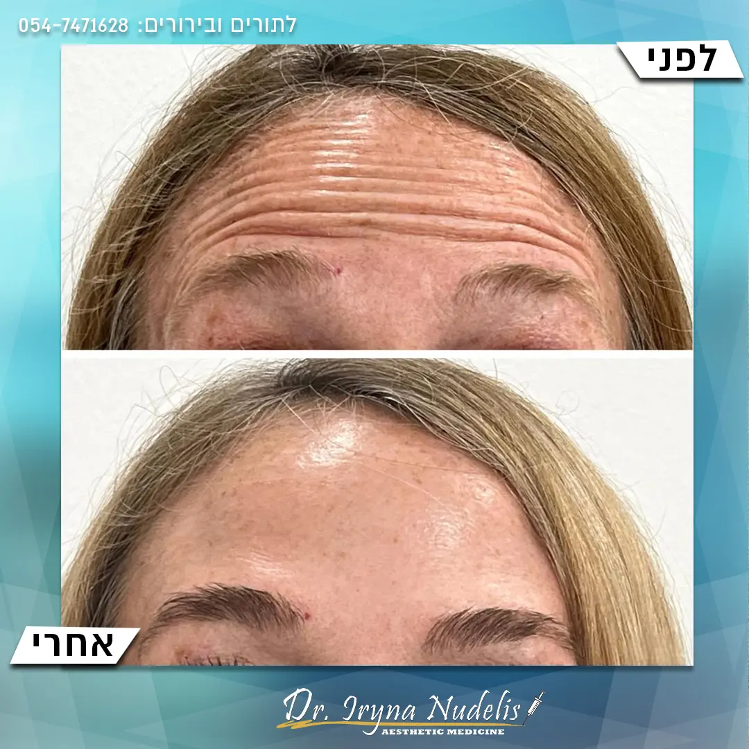 תמונת לפני ואחרי, מצח, תוצאה 17