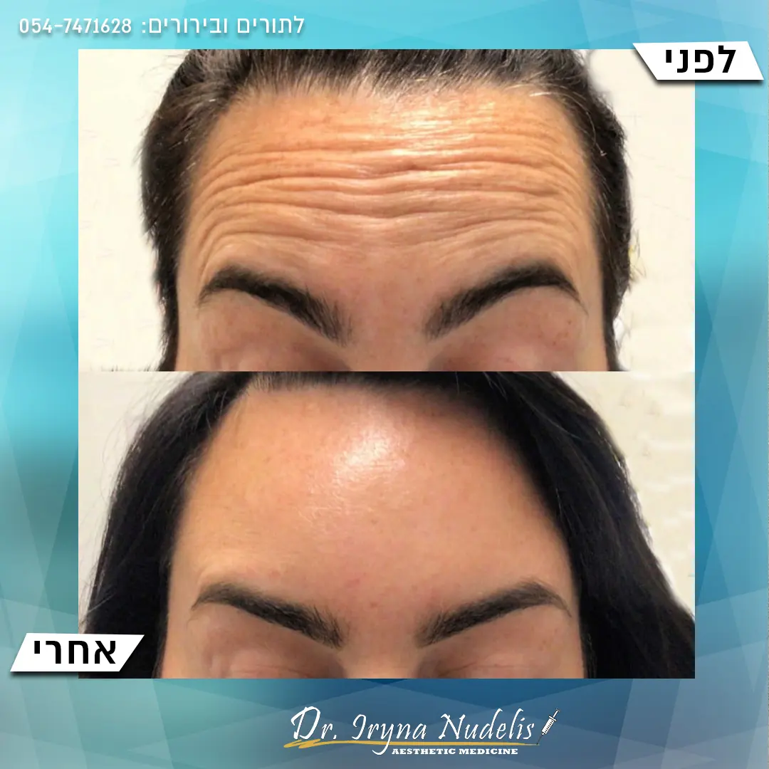 תמונת לפני ואחרי, מצח, תוצאה 18