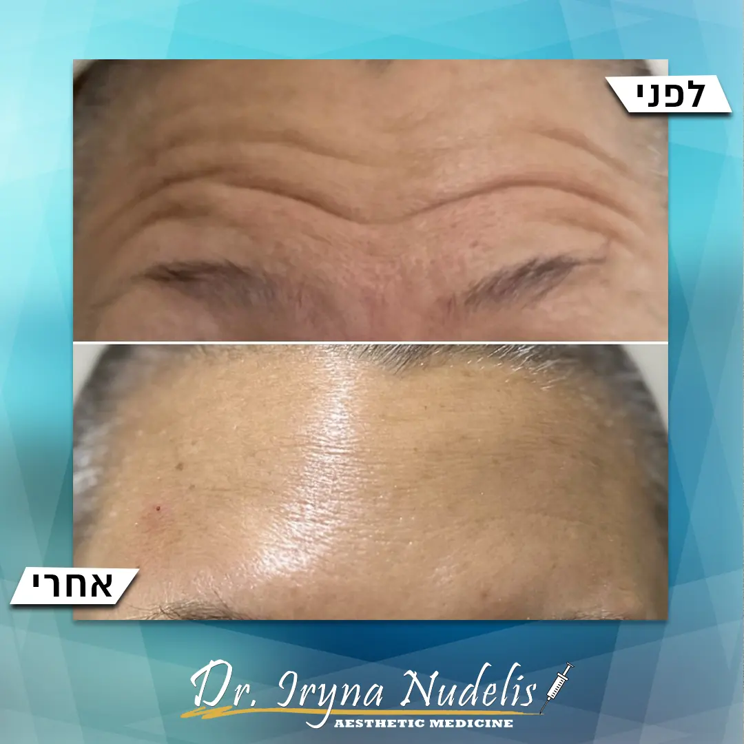 תמונת לפני ואחרי, מצח, תוצאה 19