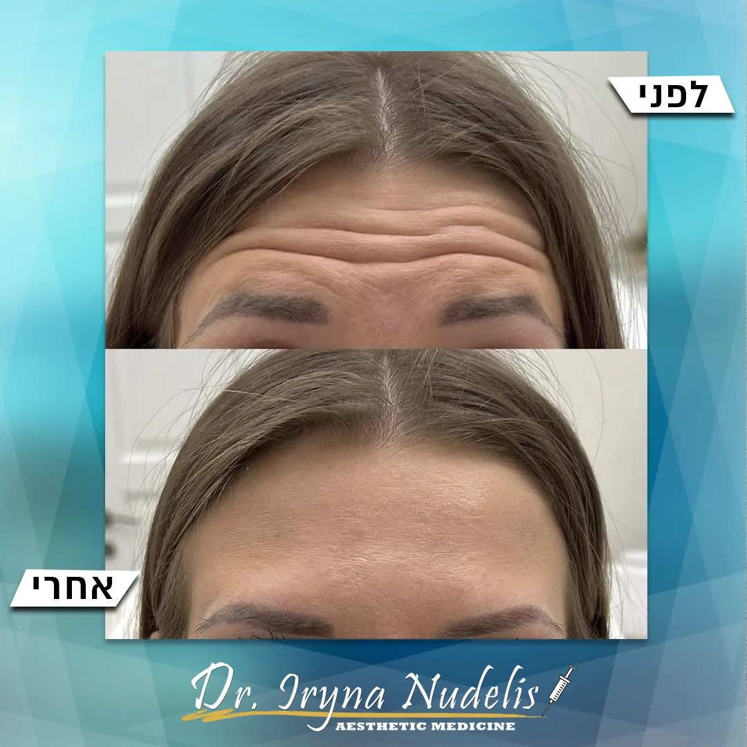 תמונת לפני ואחרי, מצח, תוצאה 20