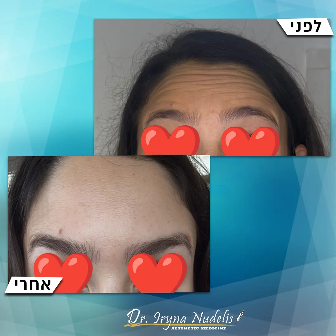 תמונת לפני ואחרי, מצח, תוצאה 21