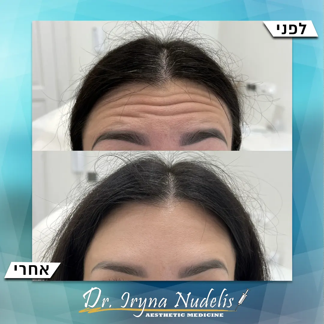 תמונת לפני ואחרי, מצח, תוצאה 22