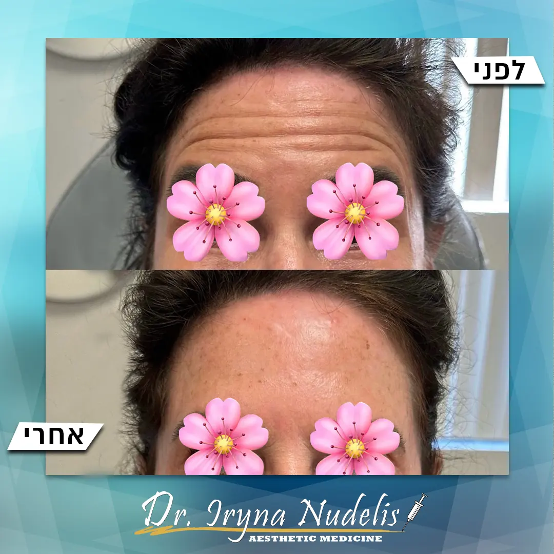 תמונת לפני ואחרי, מצח, תוצאה 23