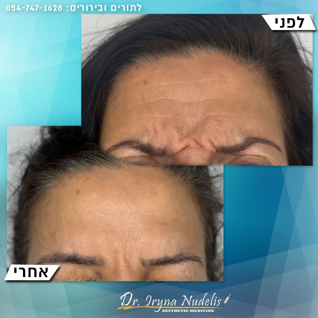 תמונת לפני ואחרי, בין הגבות, תוצאה 1