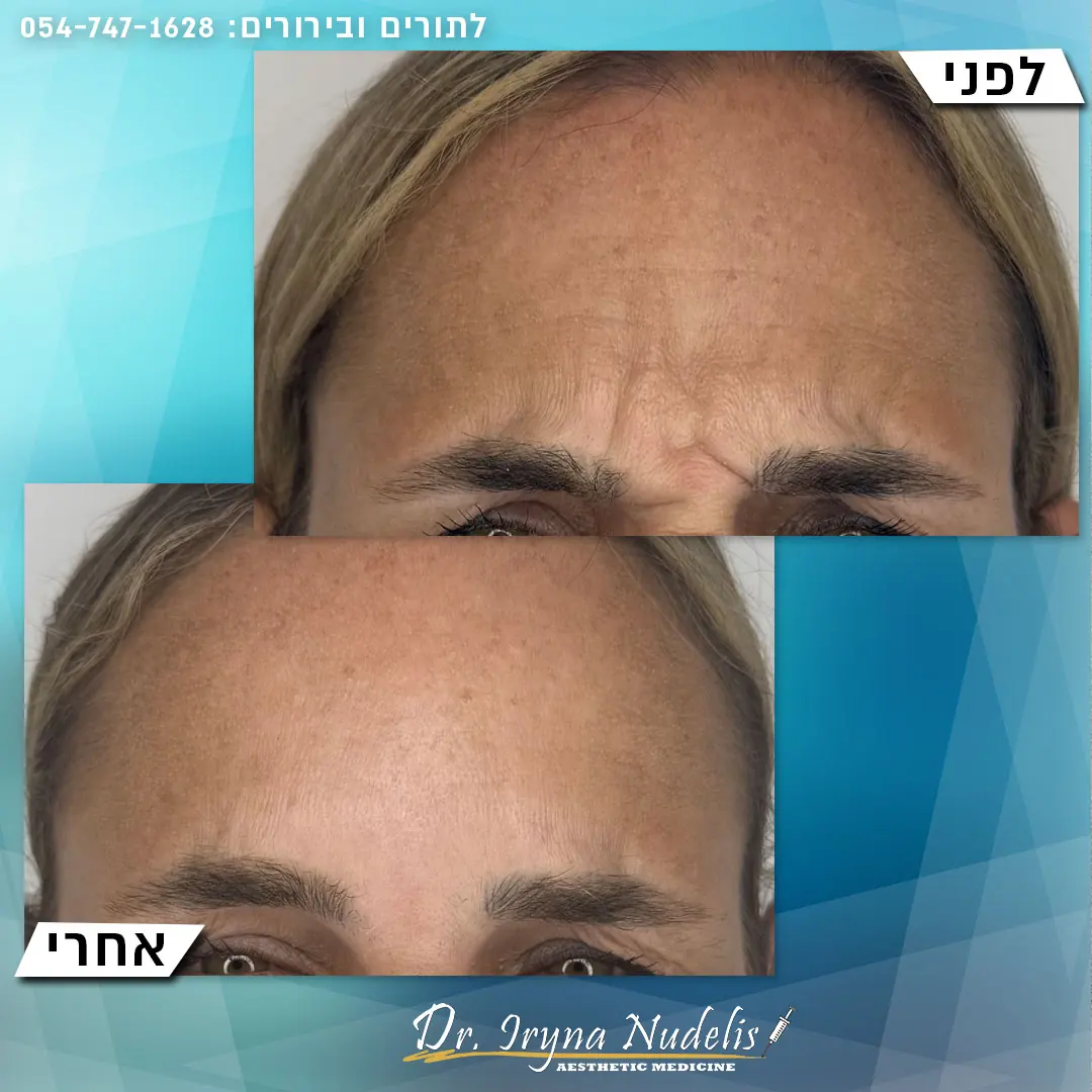 תמונת לפני ואחרי, בין הגבות, תוצאה 2