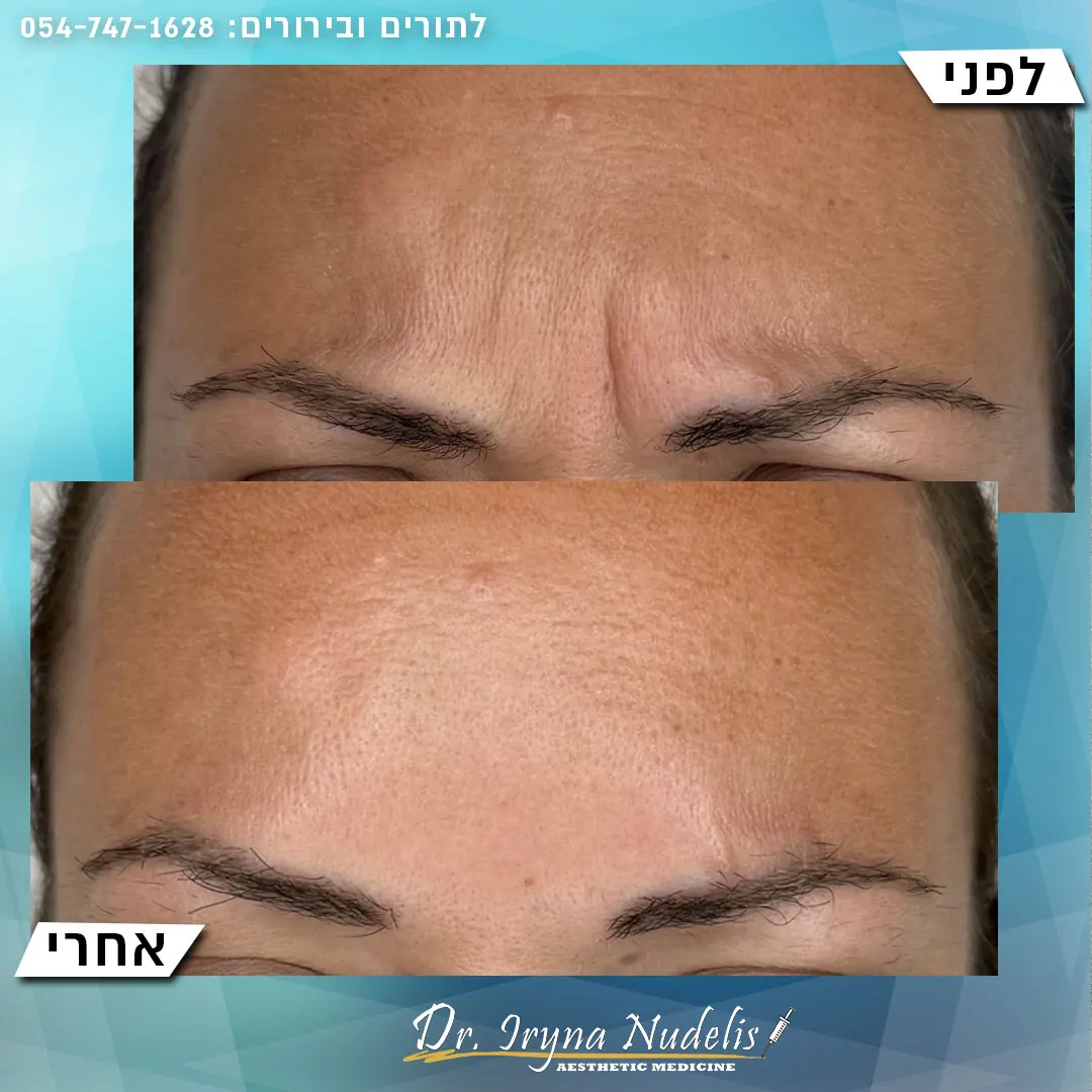 תמונת לפני ואחרי, בין הגבות, תוצאה 3