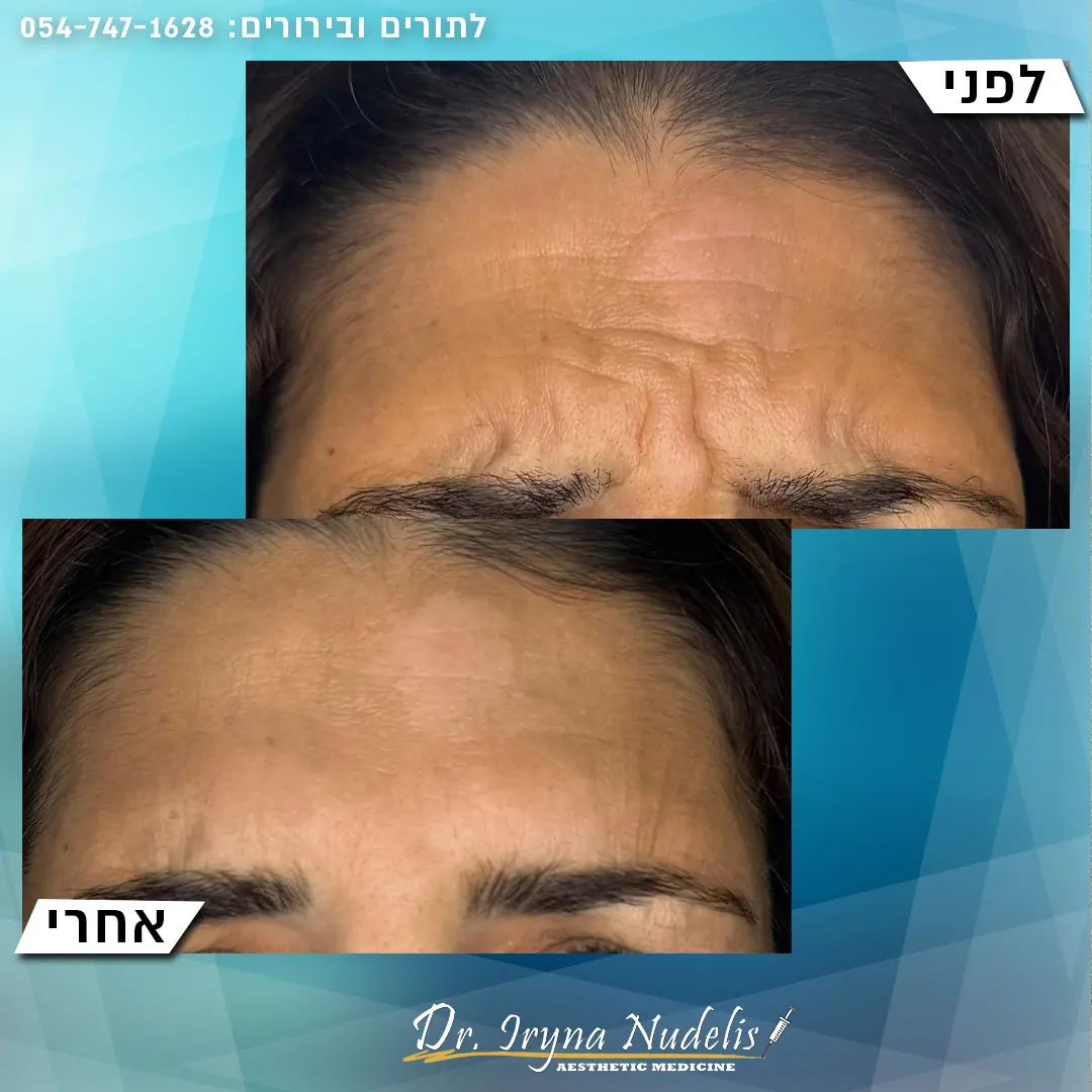 תמונת לפני ואחרי, בין הגבות, תוצאה 6