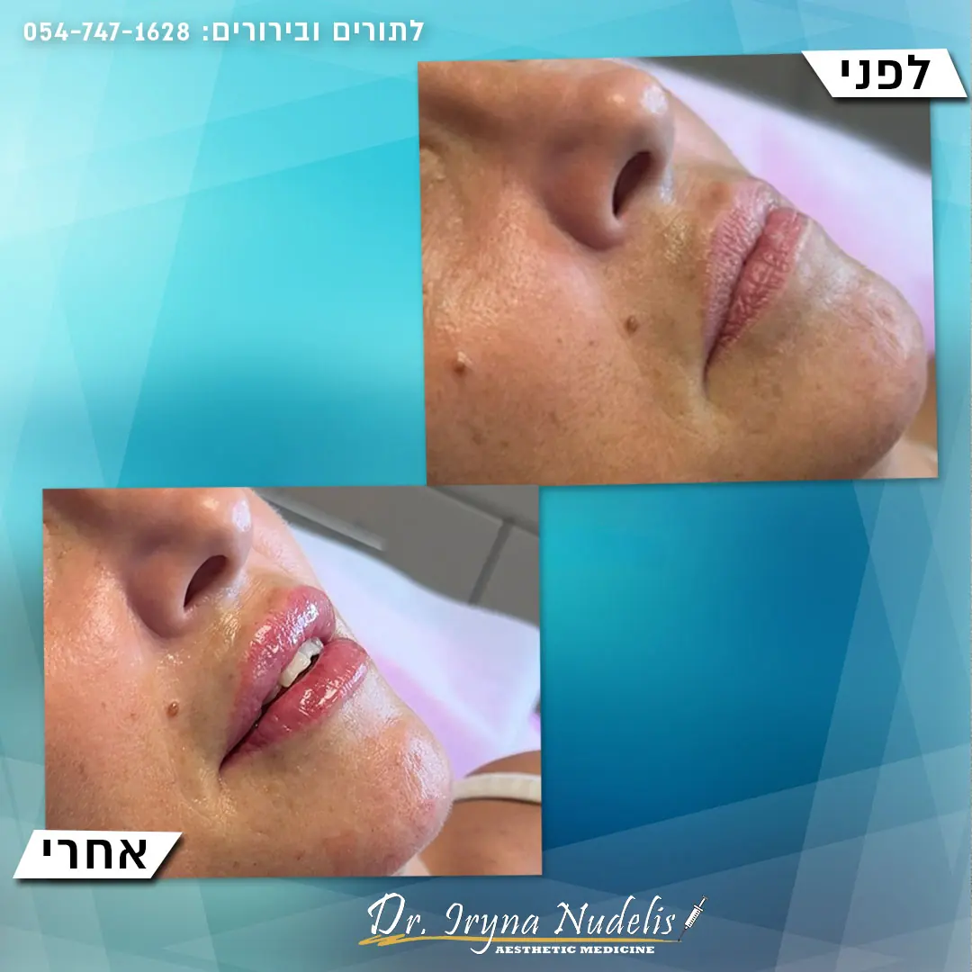 תמונת לפני ואחרי, שפתיים, תוצאה 1