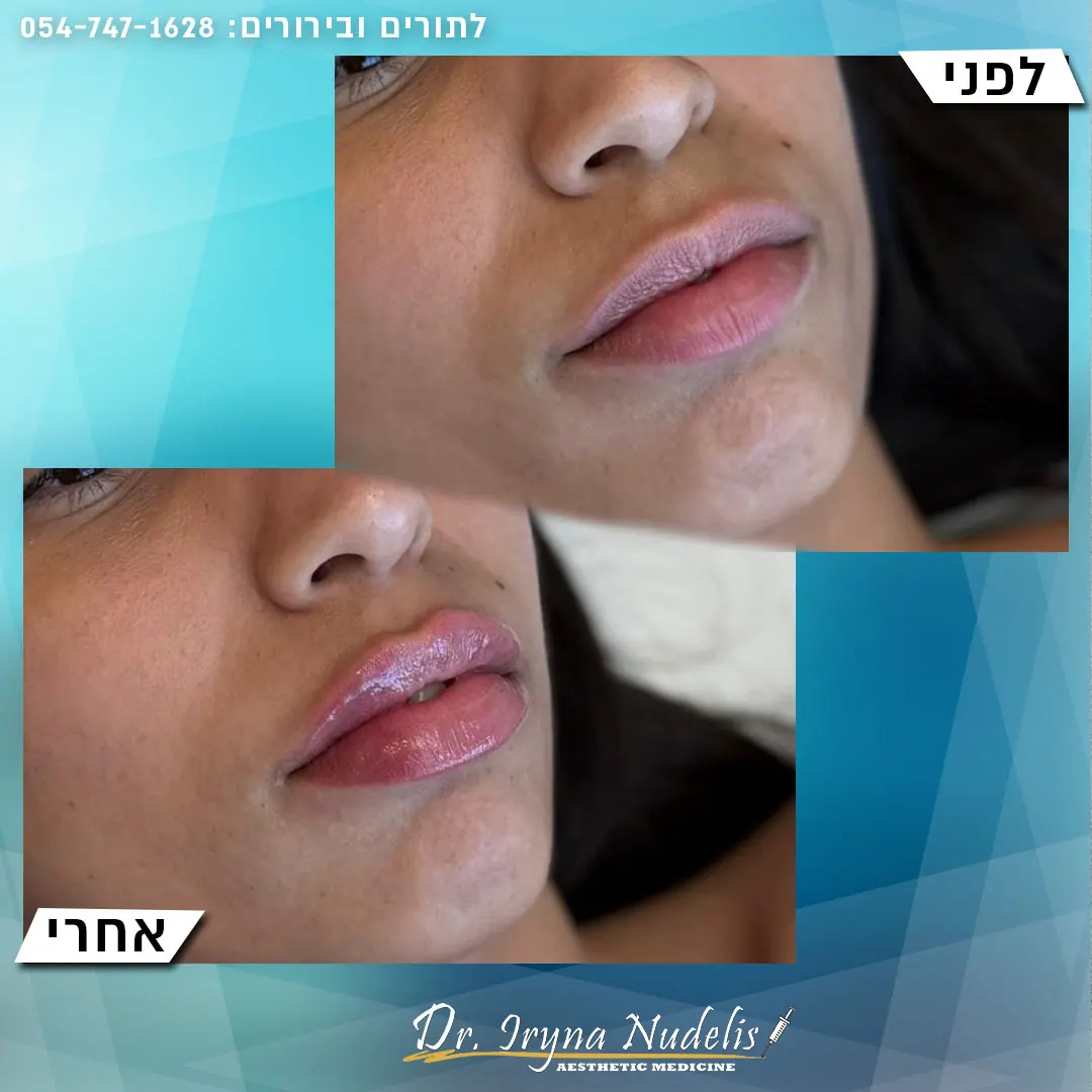 תמונת לפני ואחרי, שפתיים, תוצאה 2