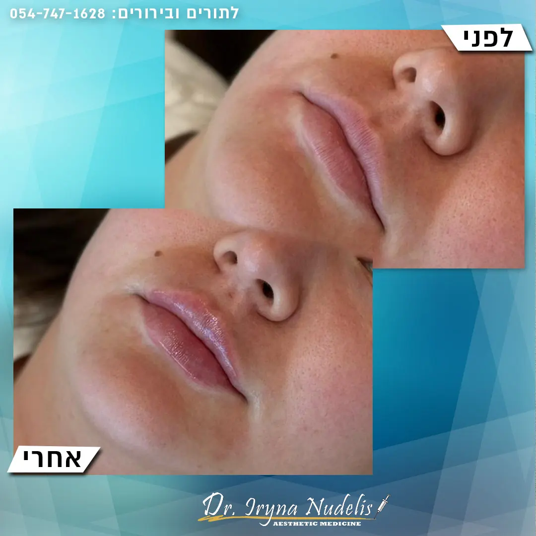 תמונת לפני ואחרי, שפתיים, תוצאה 3