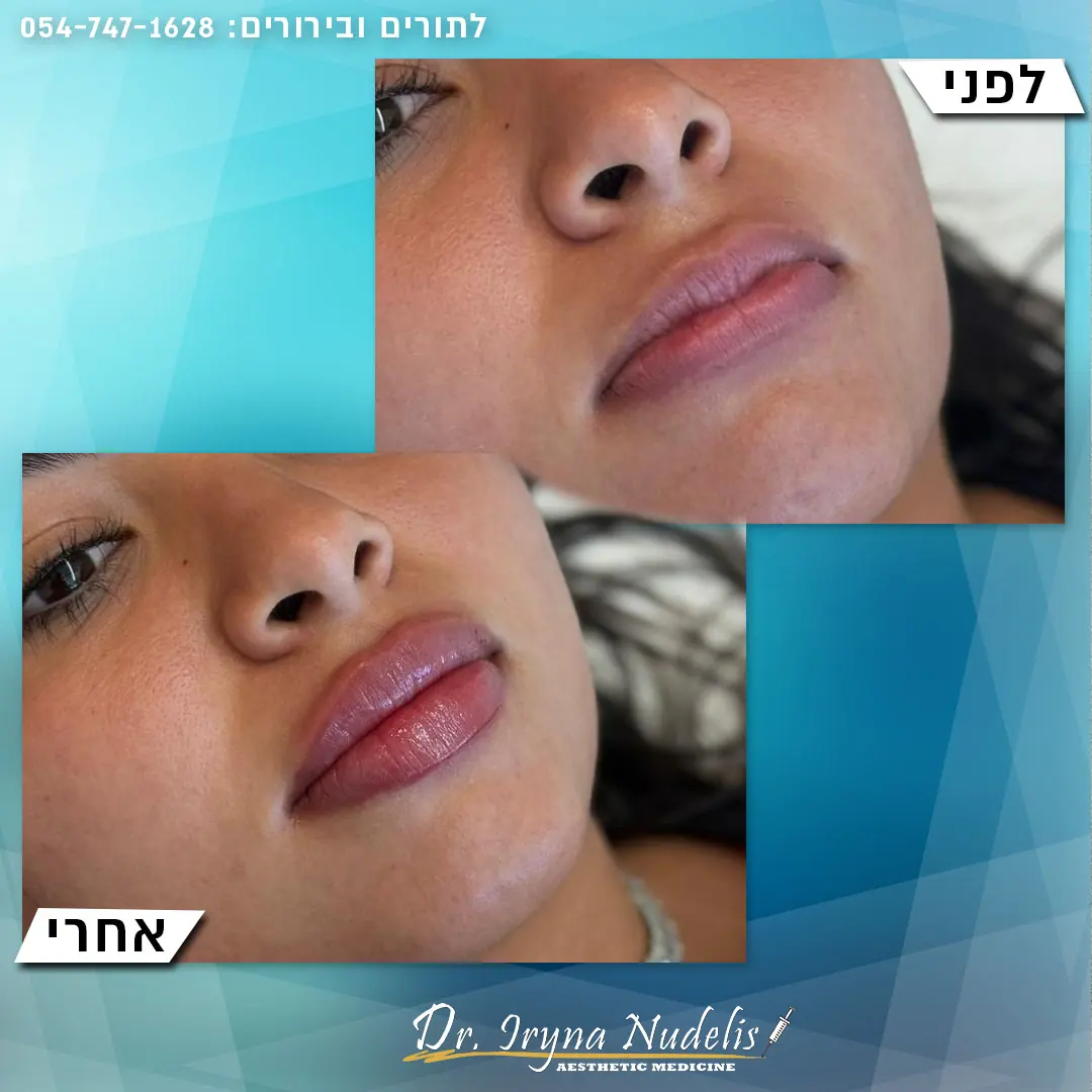 תמונת לפני ואחרי, שפתיים, תוצאה 4